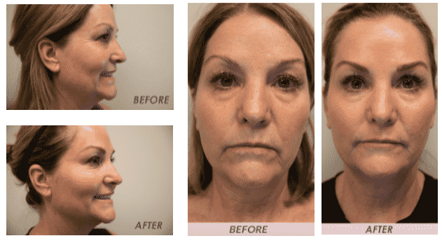 Liquid Facelift before and after