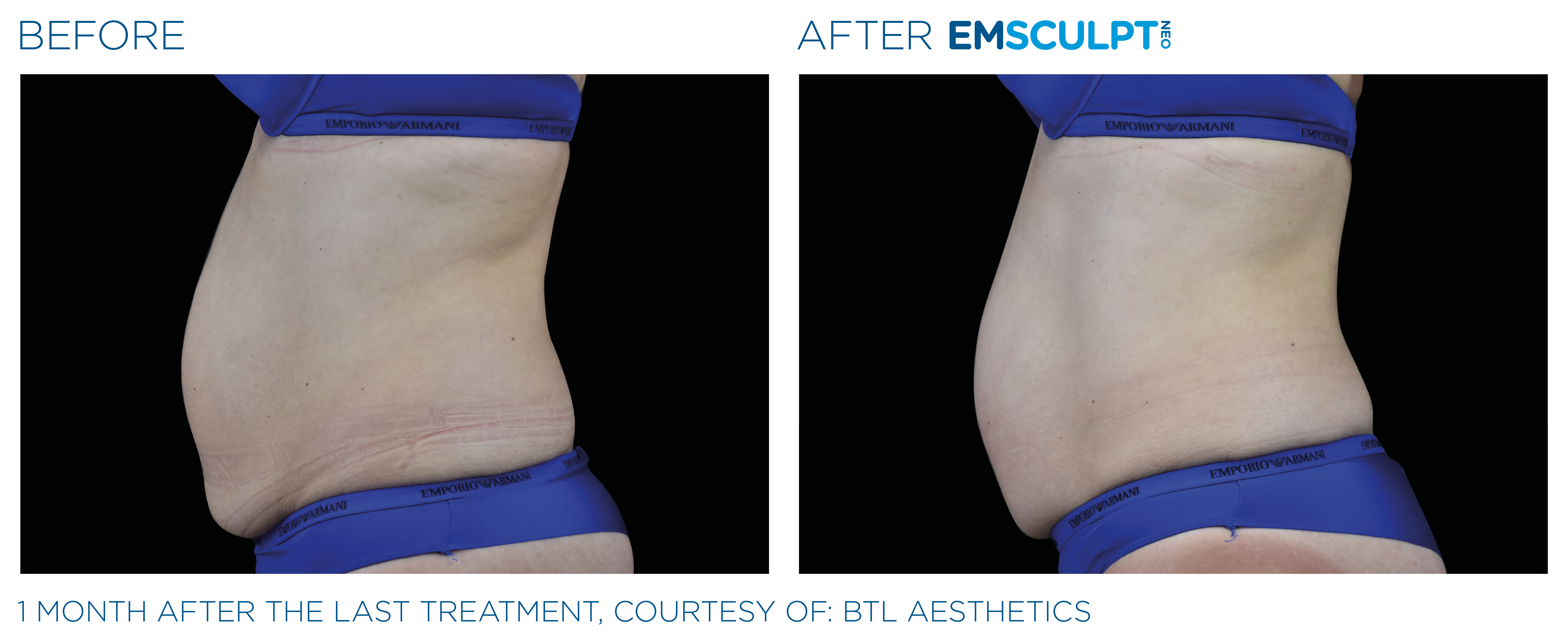 EMSCULPT NEO Before After Stomach