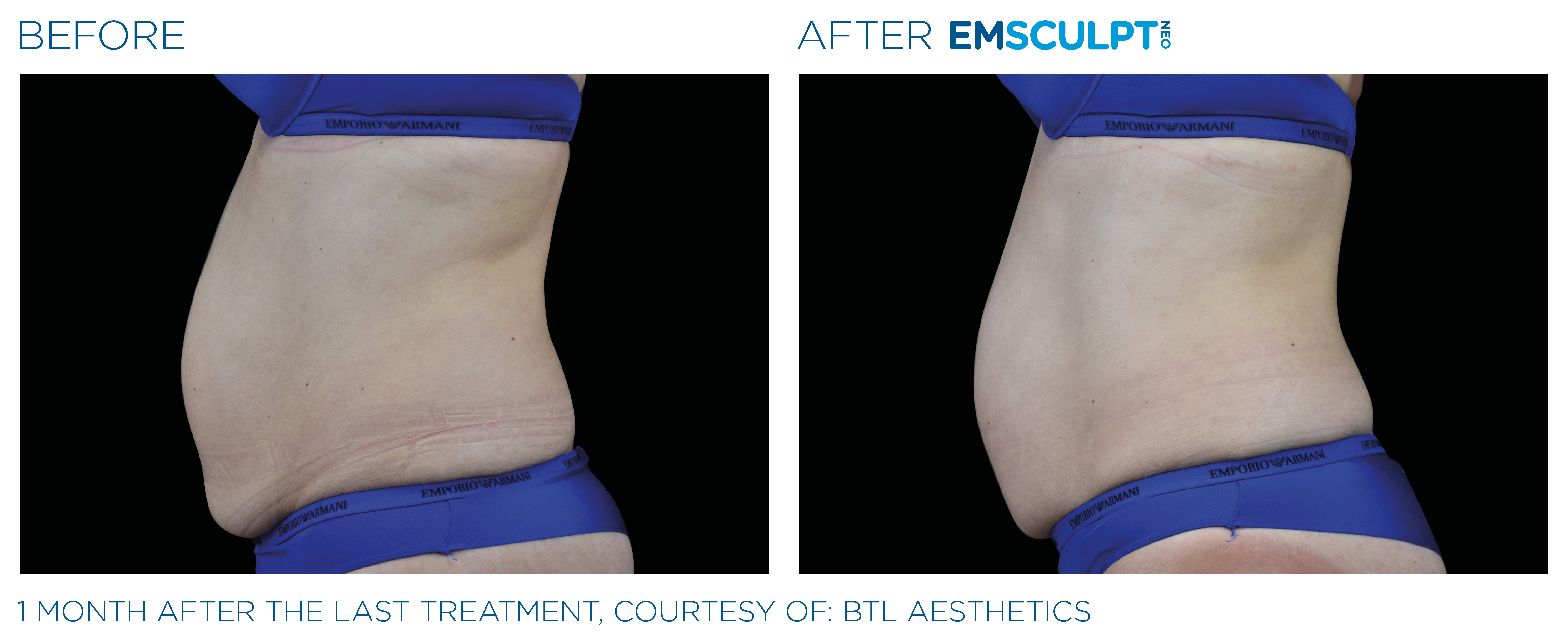 Emsculpt NEO for Abs & Abdomen Before & After