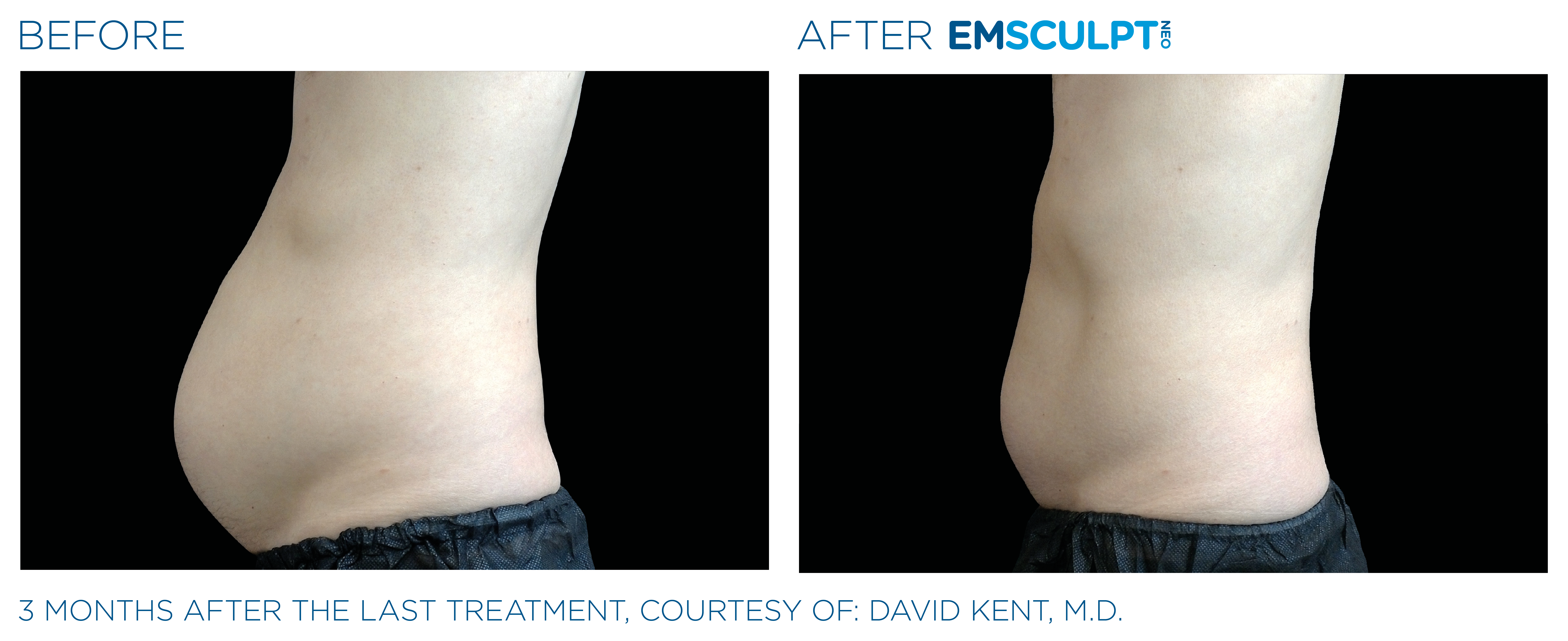 EMSCULPT NEO Before After Pictures Abdomen