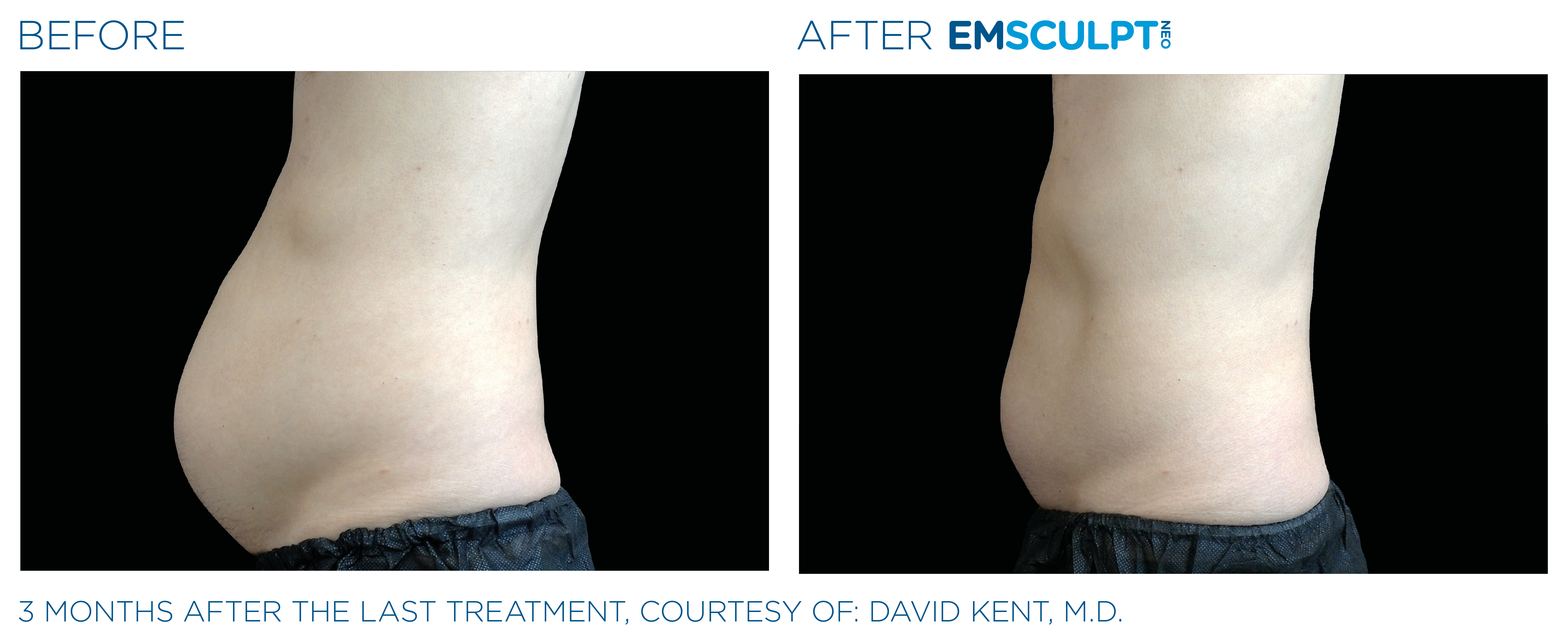 EMSCULPT BEFORE AND AFTER, REAL PATIENT RESULTS