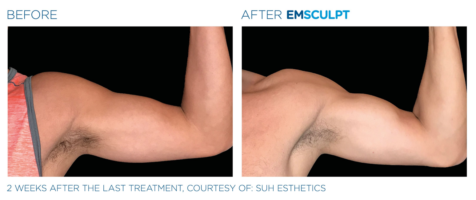 Emsculpt Neo Before After Bicep
