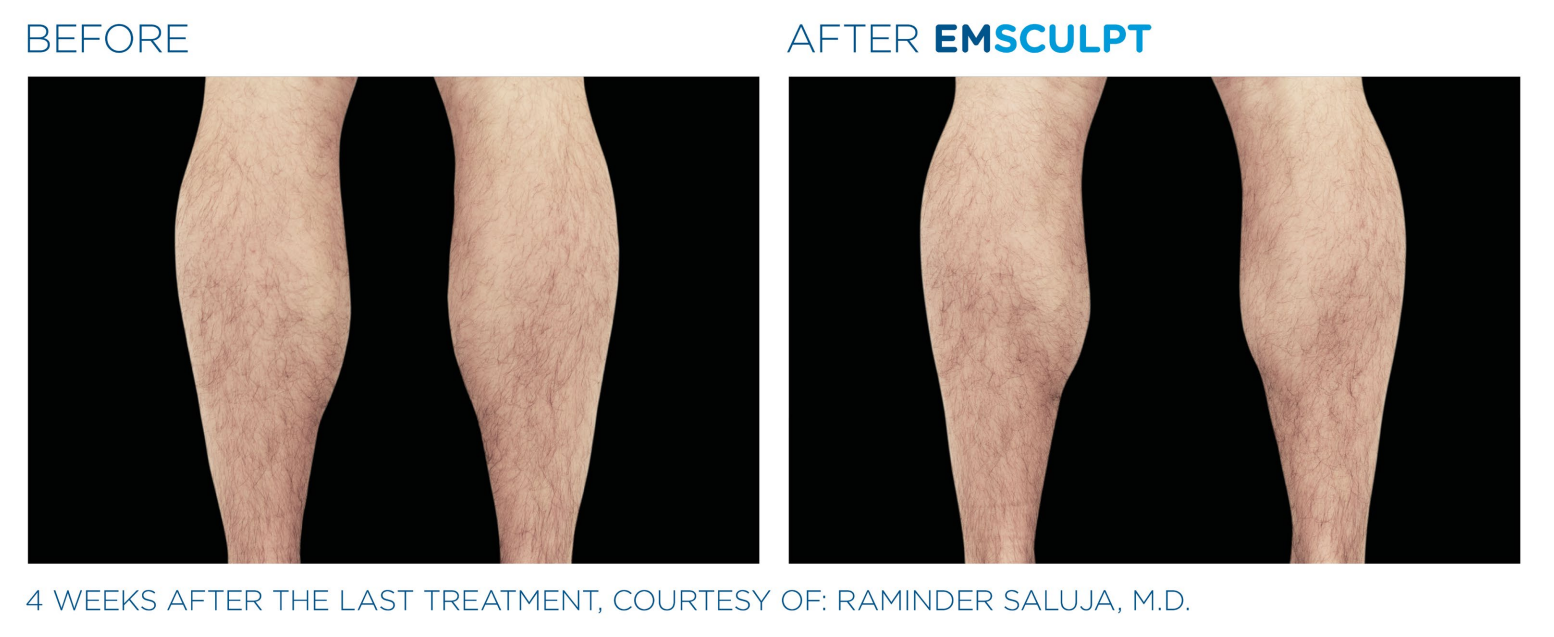 emsculpt neo before and after