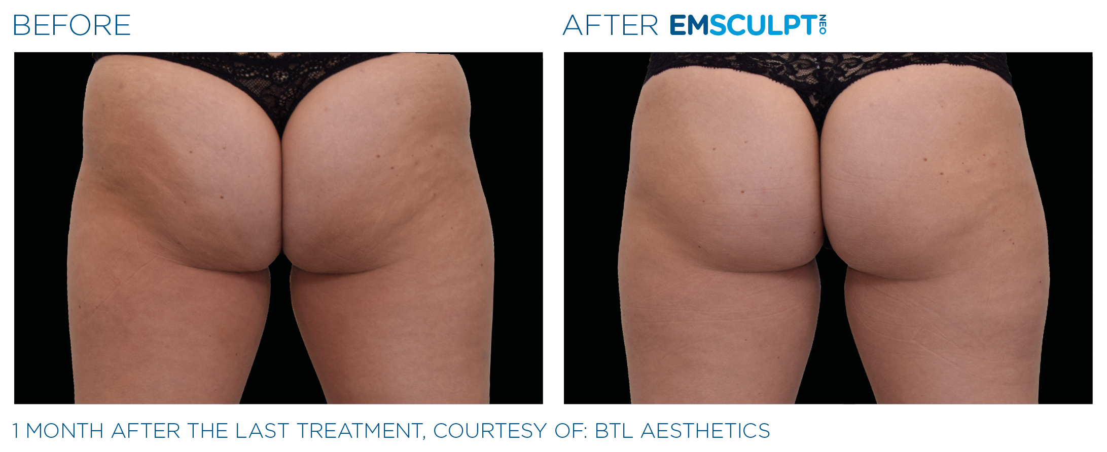 Emsculpt Neo Before and After Buttocks