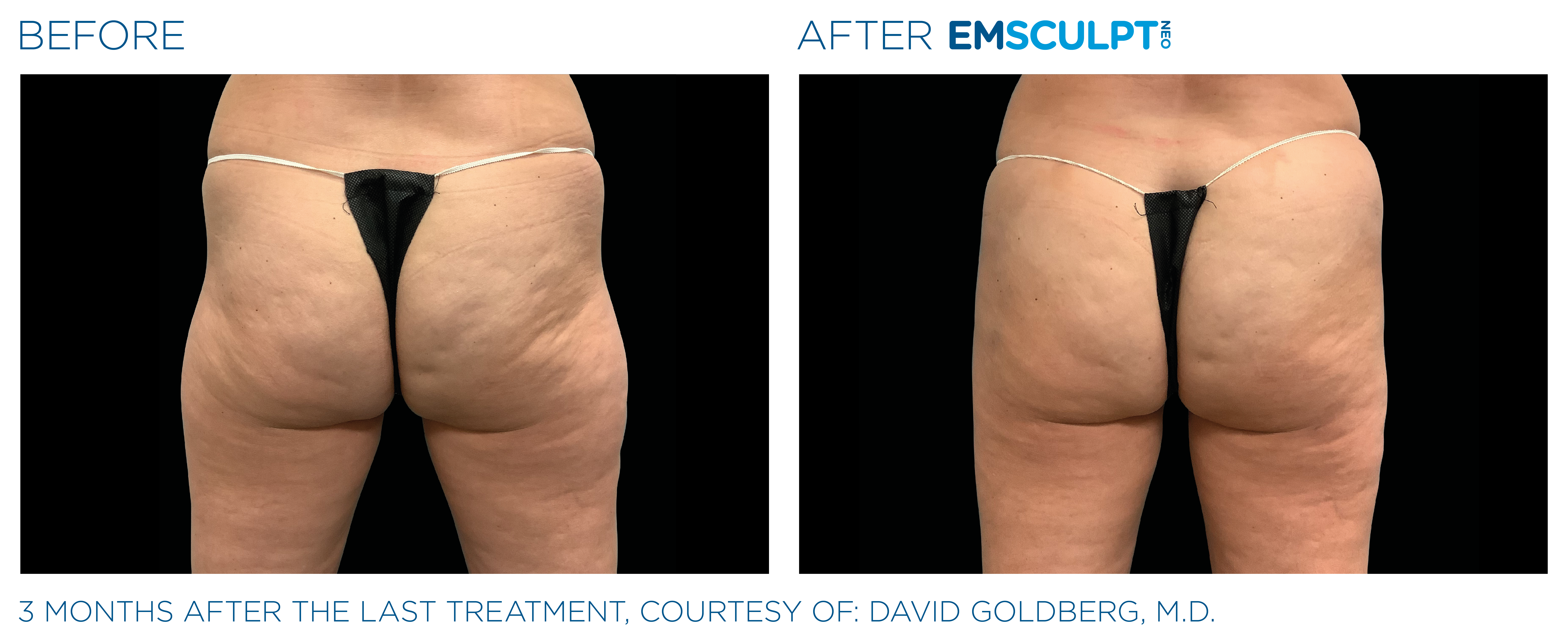 Emsculpt Neo Before and After Buttocks