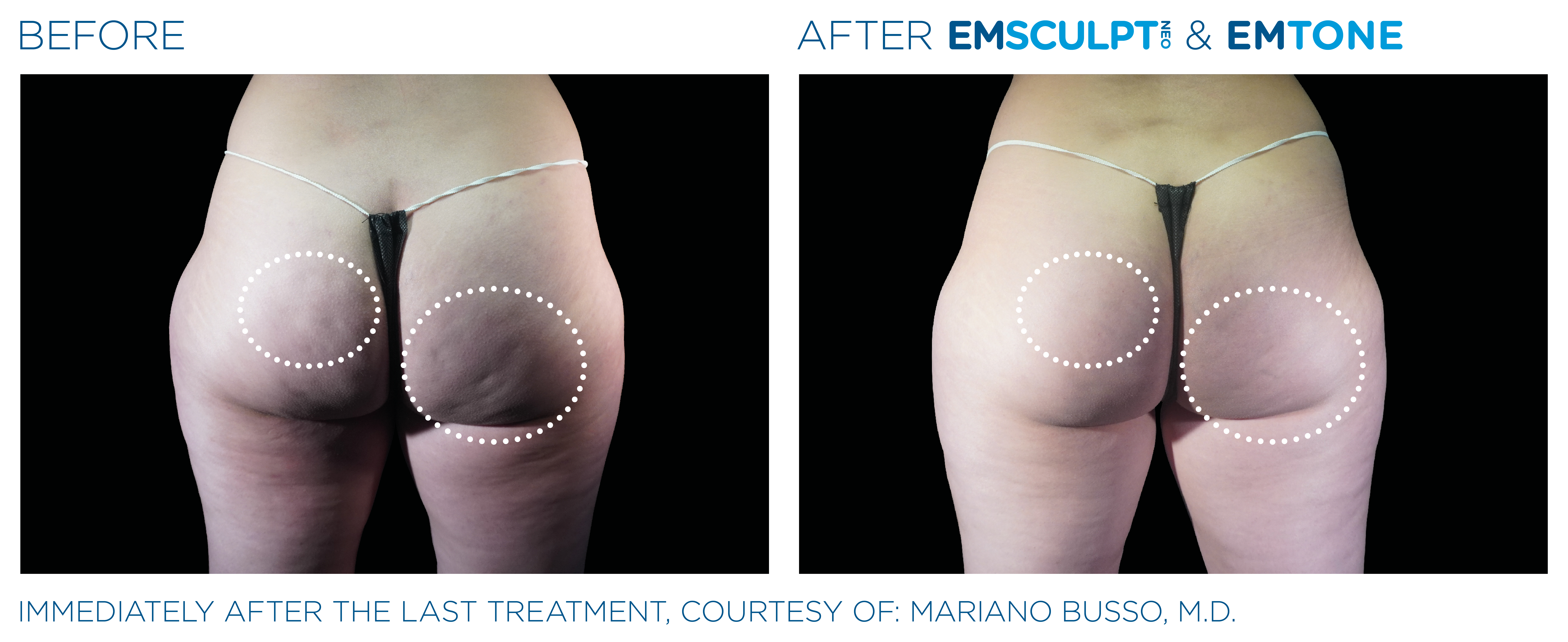 Emsculpt Neo Before and After Buttocks