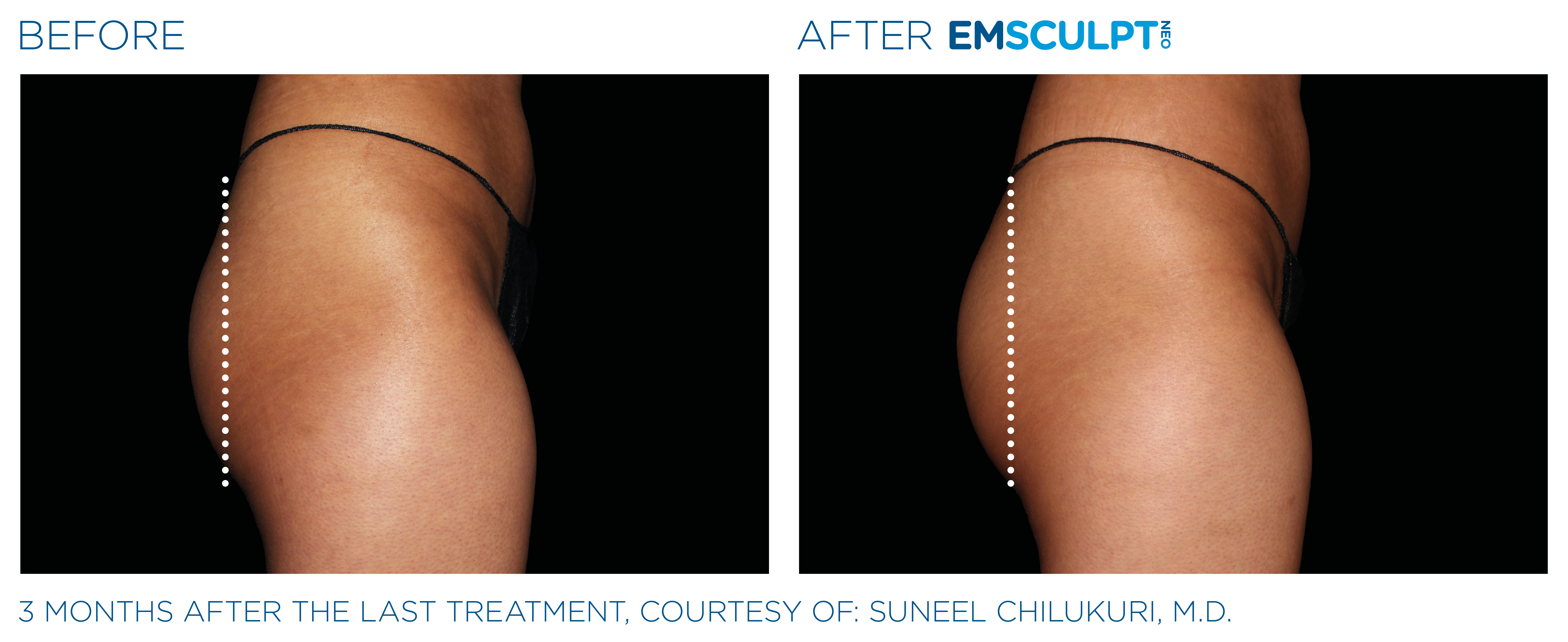 Emsculpt Neo Before and After Buttocks
