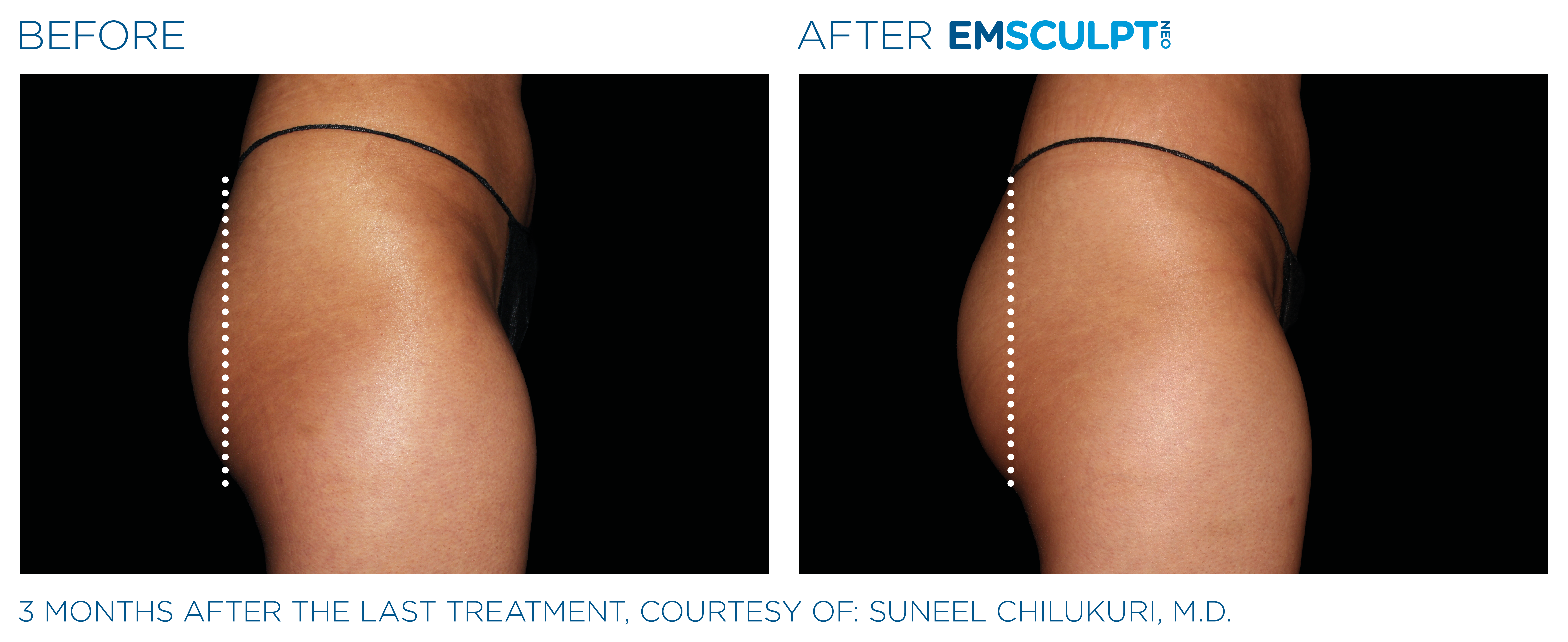 EMSCULPT NEO Thighs Treatment