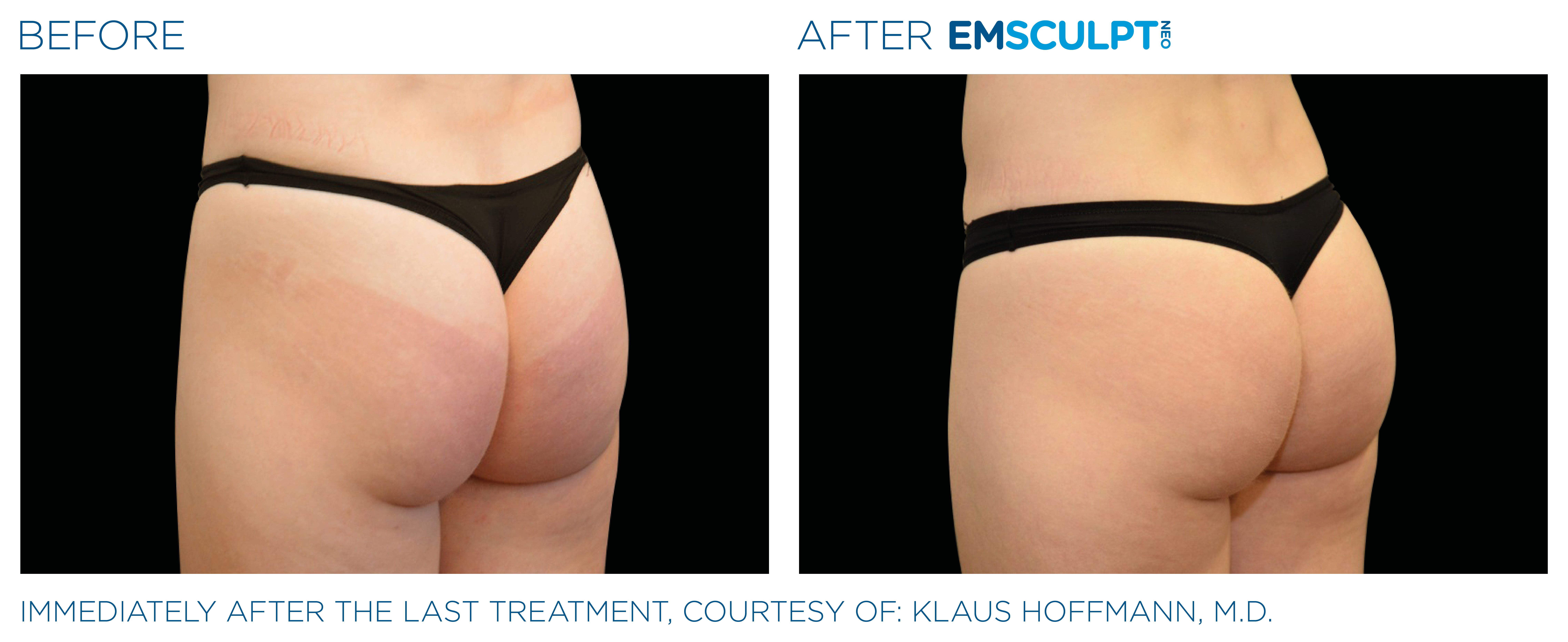 EMSCULPT NEO BEFORE and AFTER buttocks