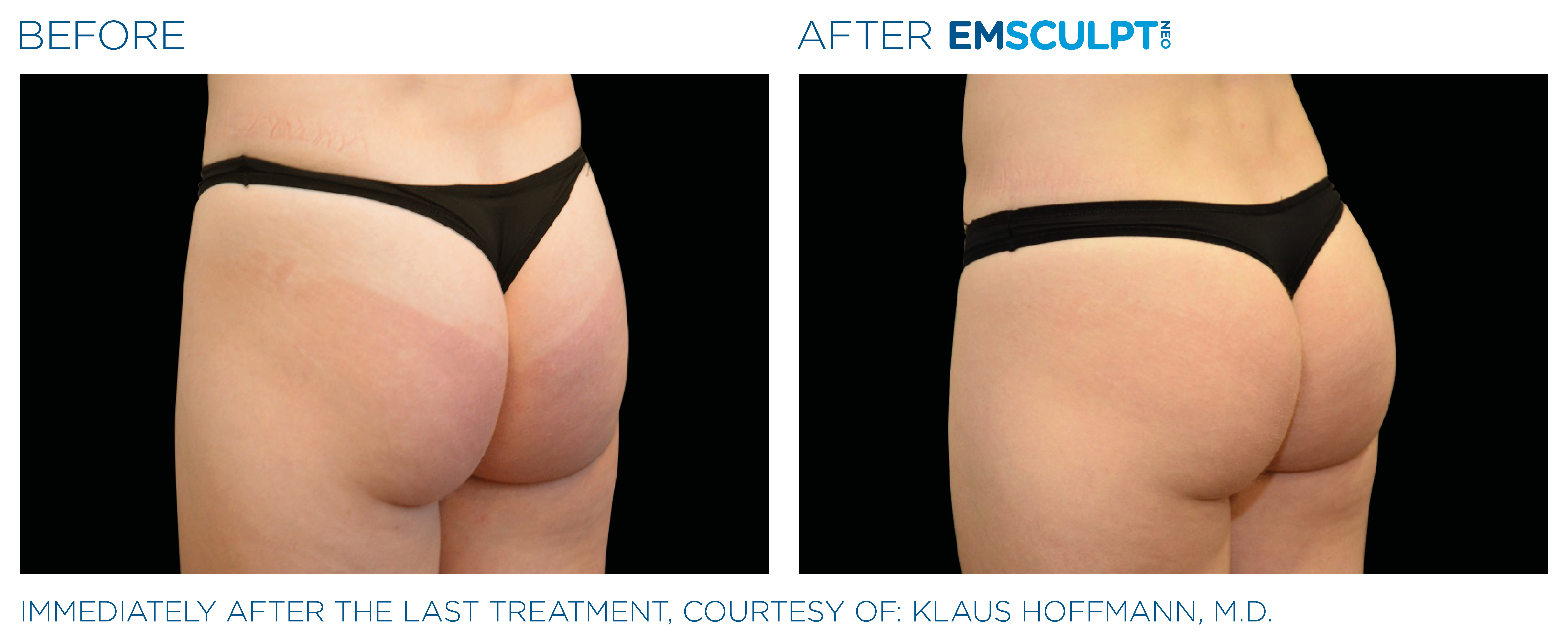 Emsculpt NEO Before and After Pictures - Cunningham Clinic