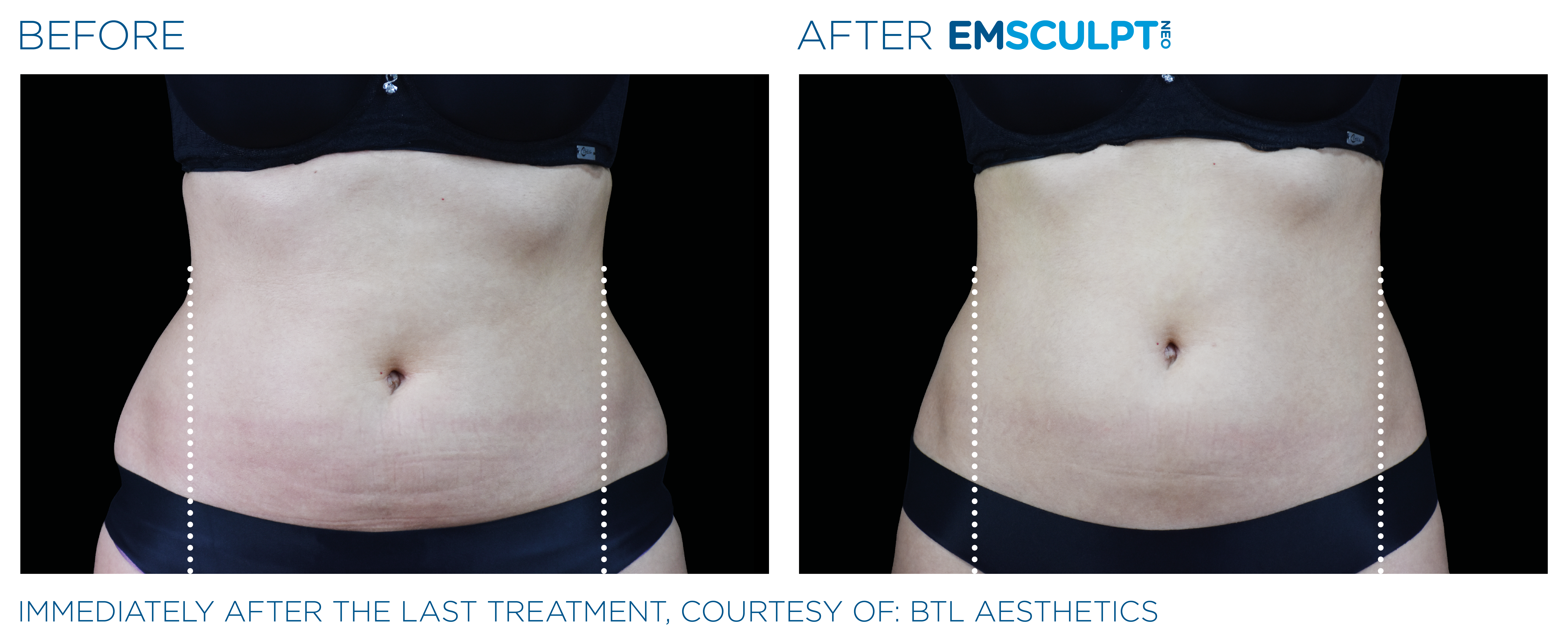 EMSCULPT NEO Before After Pictures Abdomen