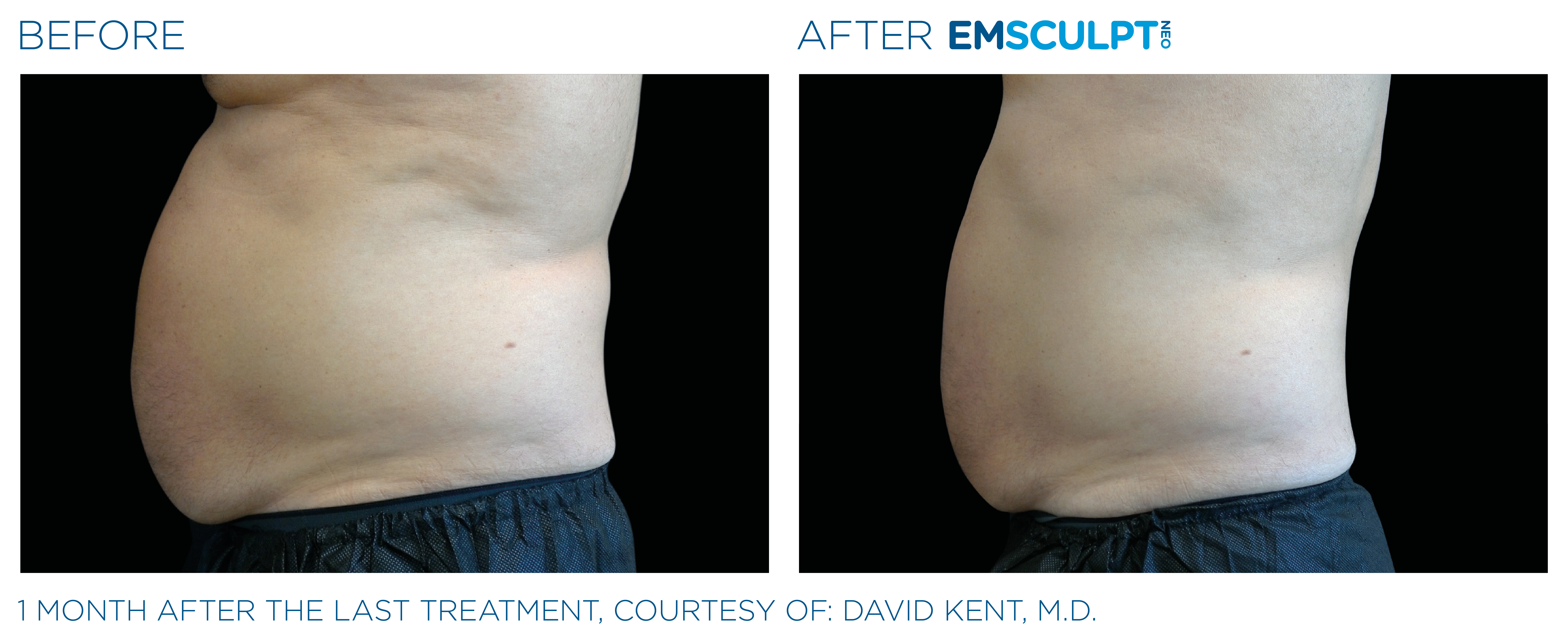 EMSCULPT NEO Before and After Pictures Abdomen