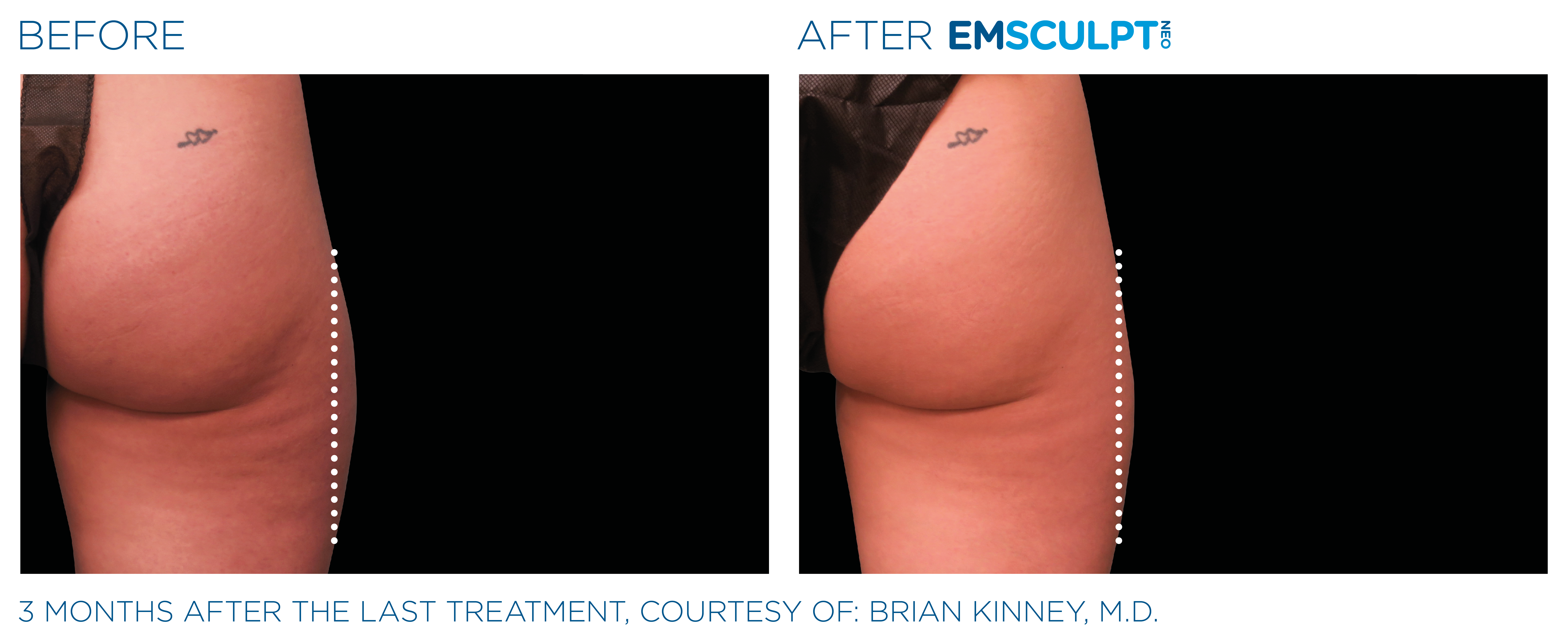 Emsculpt NEO Before and After Thighs