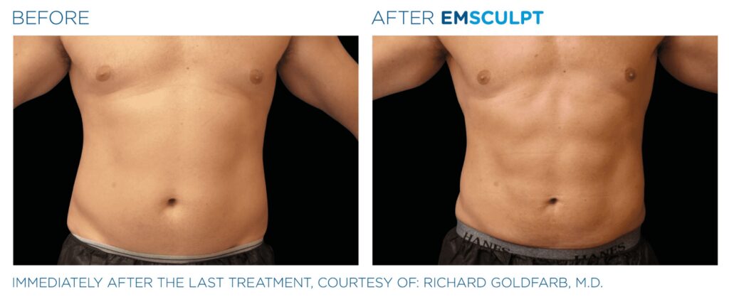 Emsculpt NEO Before And After Pictures - Cunningham Clinic