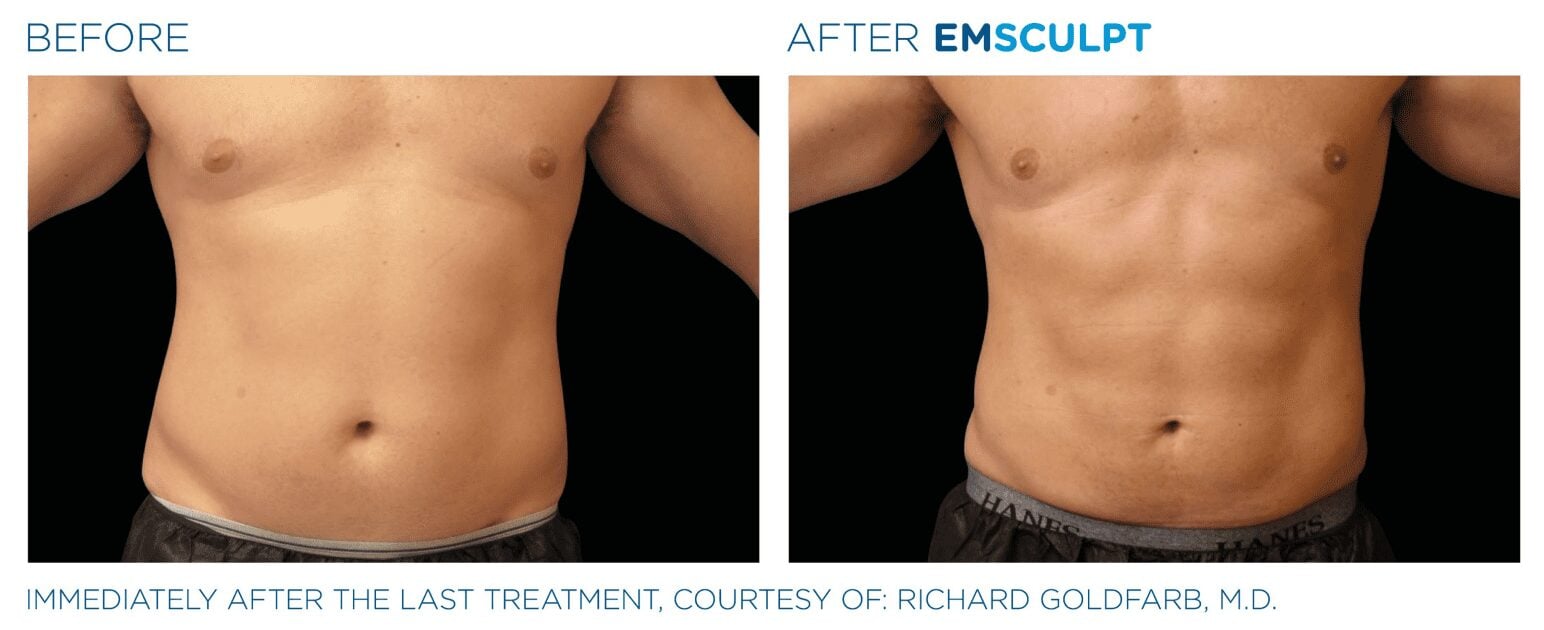 EMSCULPT NEO Before After Pictures Abdomen