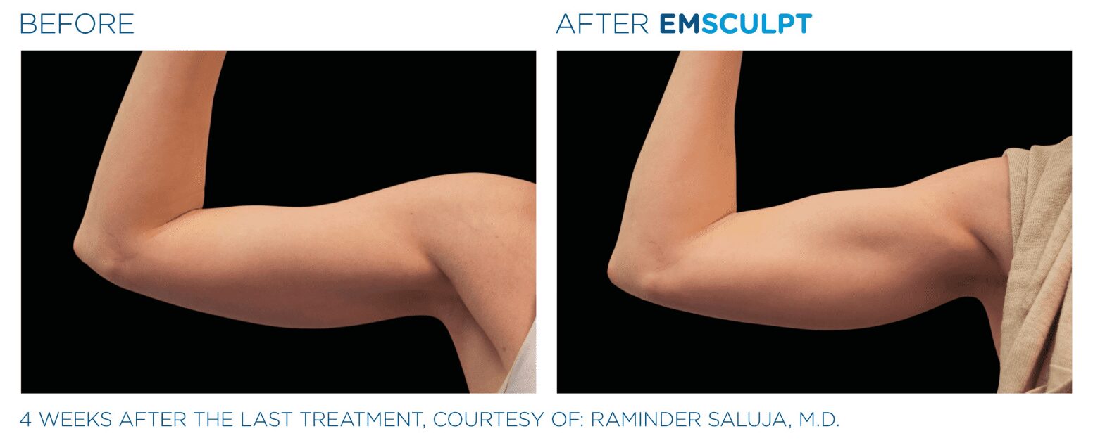 EMSCULPT NEO BEFORE and AFTER - STOMACH arms