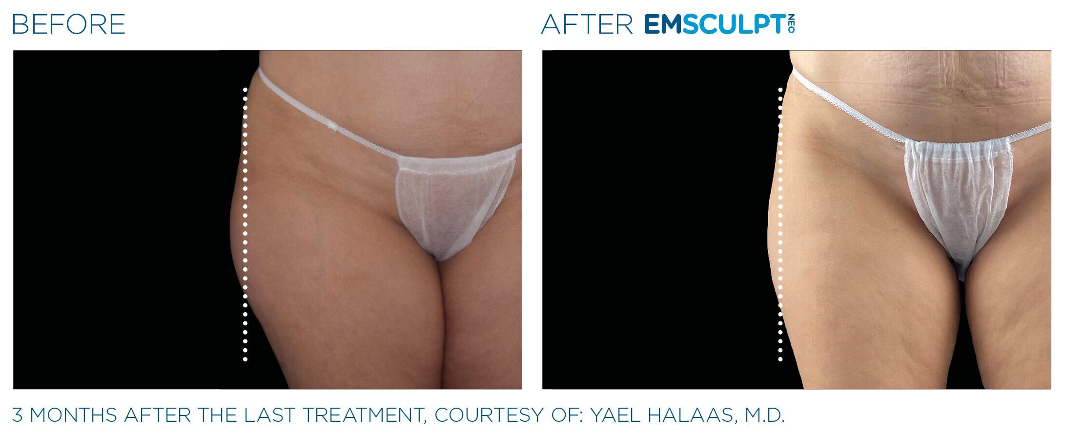 Emsculpt NEO Before and After Thighs