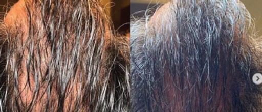 Hair Restoration with Stem Cells