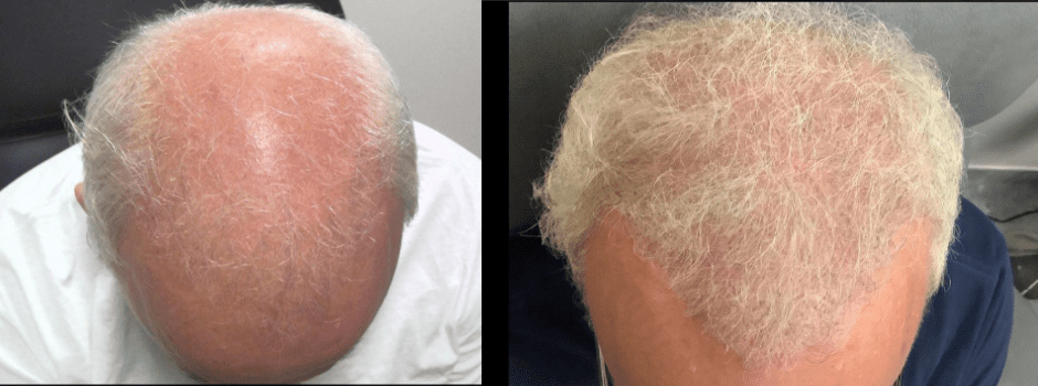 Exosome Hair Restoration Treatment