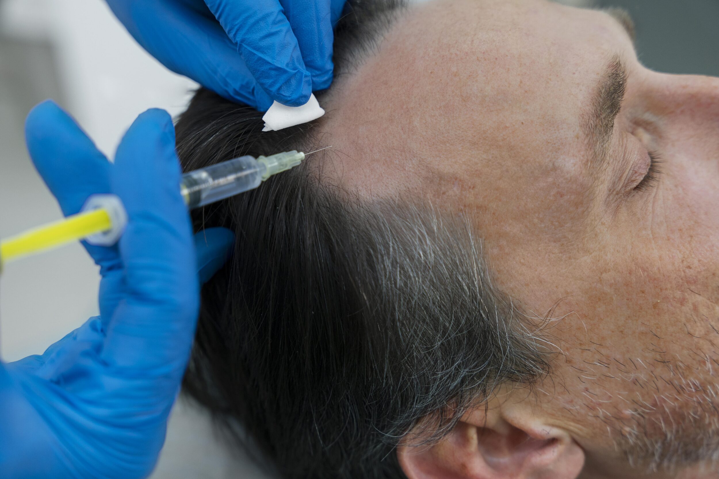 Hair Restoration with Exosomes Denver